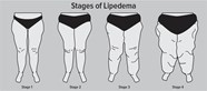 Does Compression Help Lipedema At Lara Bunton Blog Does Compression Help Lipedema At Lara Bunton Blog
